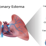 Vital Role of Respiratory Rehab in Treating Pulmonary Edema