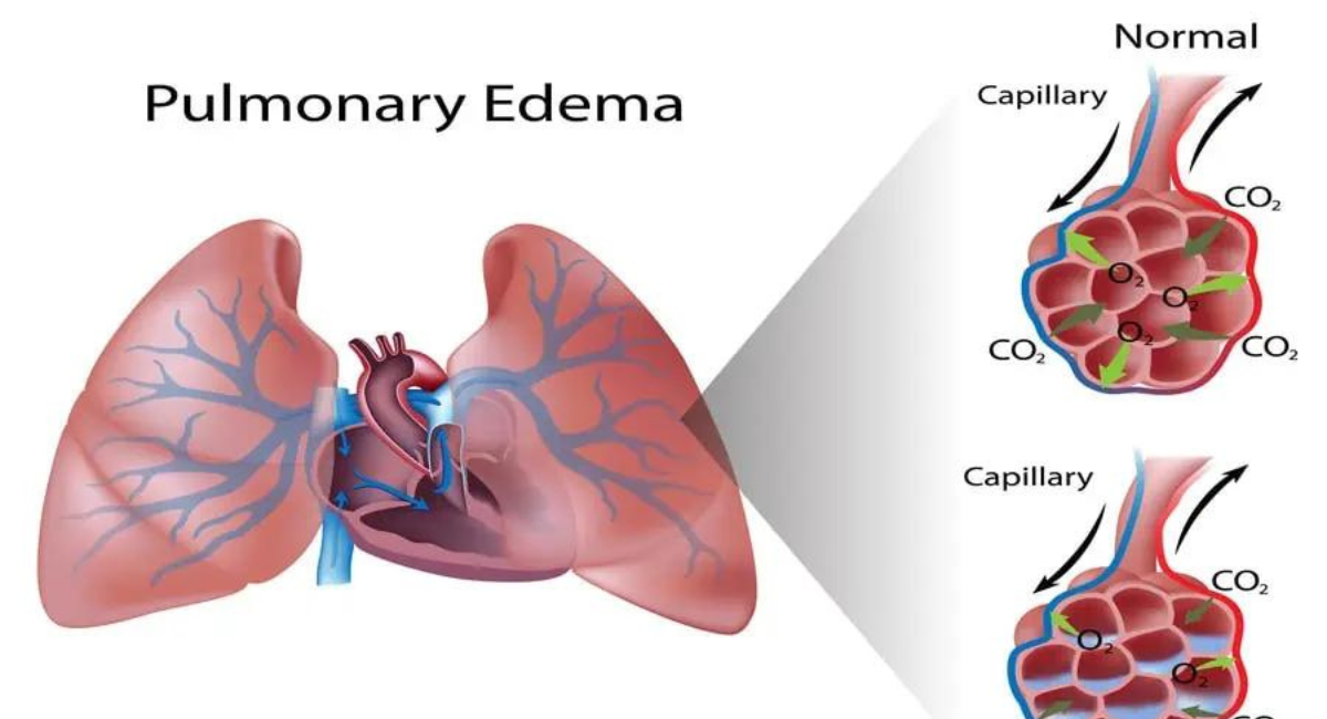 Vital-Role-of-Respiratory-Rehab-in-Treating-Pulmonary-Edema