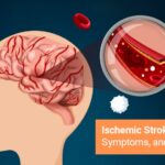 Ischemic Stroke: Causes, Symptoms and More