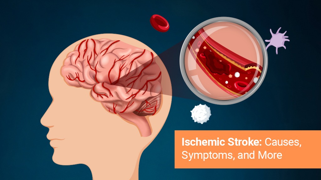 Ischemic Stroke: Causes, Symptoms and More