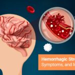Hemmoragic stroke-causes-symptoms-and-more/