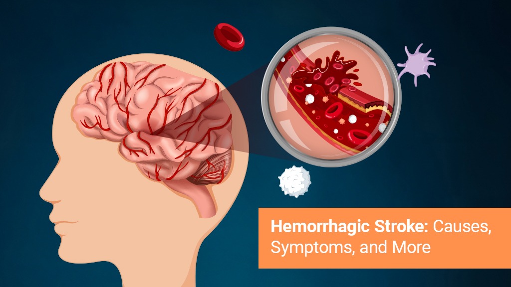 Hemmoragic stroke-causes-symptoms-and-more/